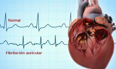 Fibrilación auricular, una de las enfermedades cardíacas más prevalentes en el país