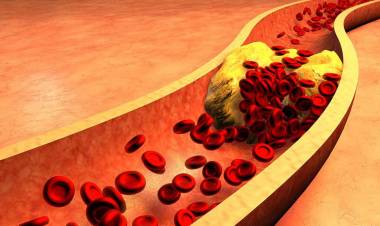 Triglicéridos altos: cómo bajarlos y en qué se diferencian del colesterol