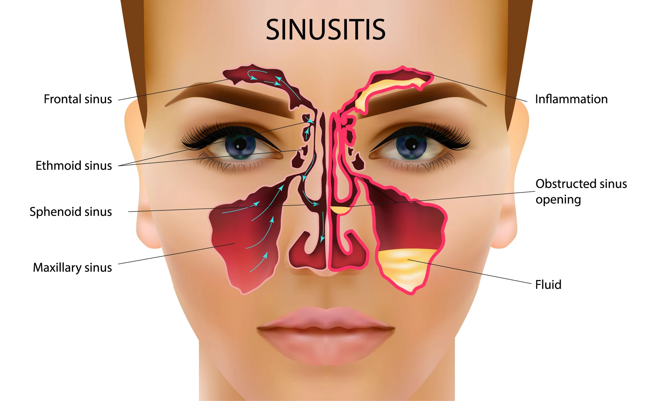 Sinusitis  : síntomas, tratamiento y todo lo que tenés que saber sobre esta afección