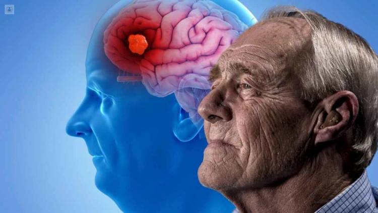 Alzheimer : las señales a tener en cuenta para lograr detectar esta enfermedad