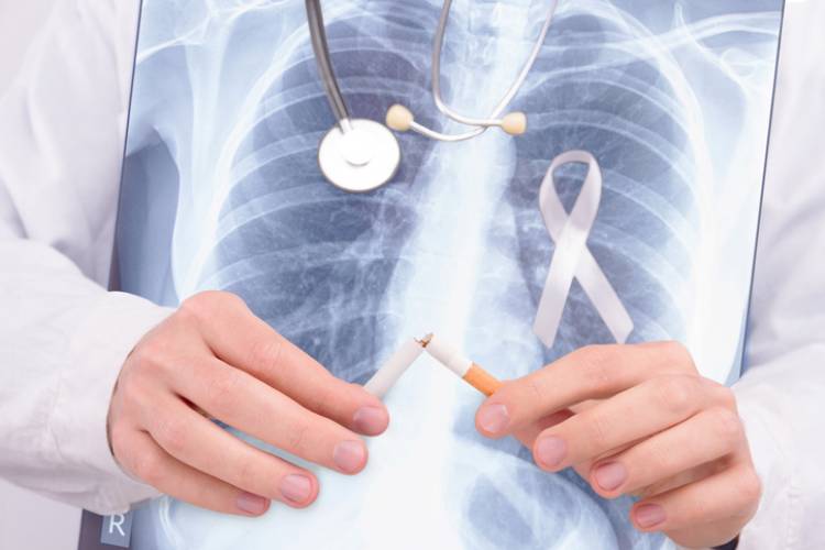 Cáncer de pulmón : conocer las características de cada tumor es clave para definir el tratamiento